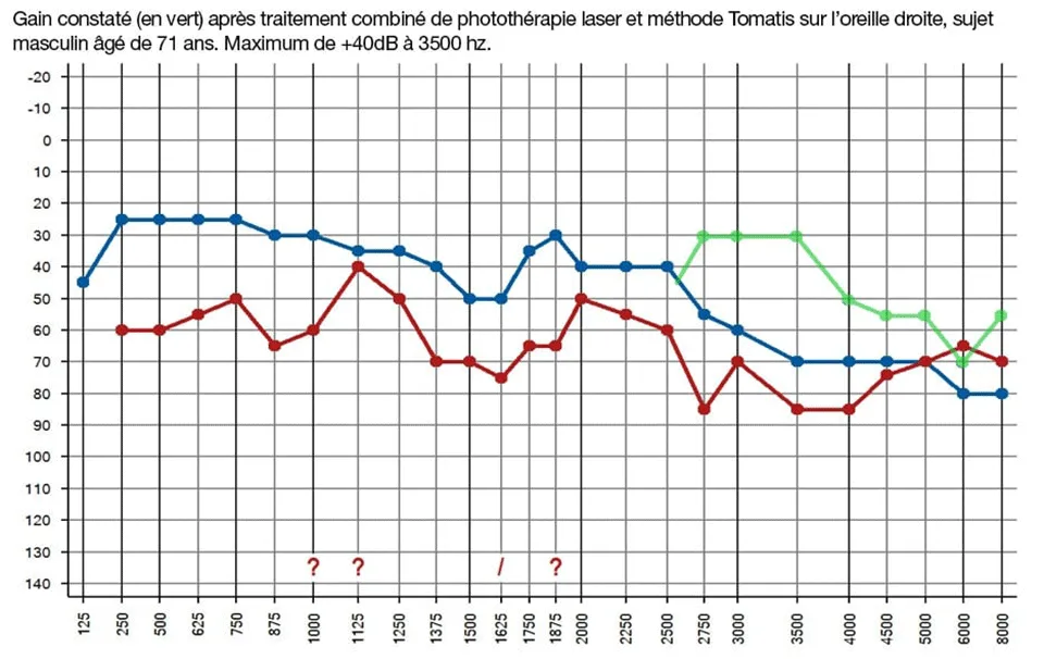 perte auditive et amélioration après 6 mois